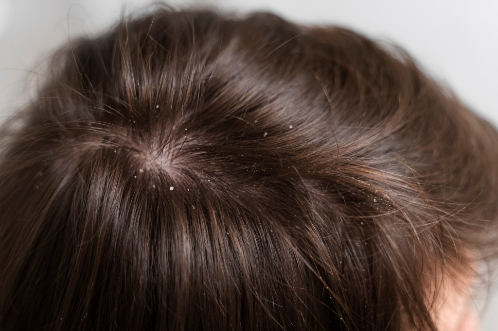 Dandruff-Effective Natural Treatment and&nbsp;Prevention